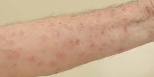 scabies control how to get rid of scabies