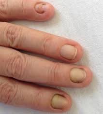 a curious case of yellow nail syndrome