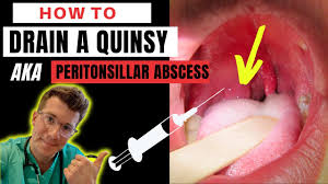 how to drain a quinsy aka