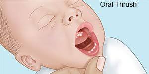 infant thrush what you need to know