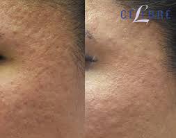 acne scar removal before and after