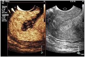 contrast enhanced ultrasound imaging of