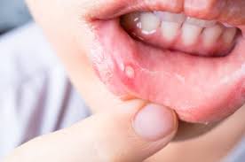 should you try to pop a canker sore