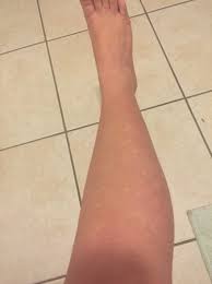 white spots on arms and legs pic