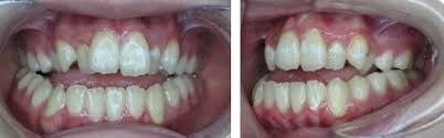 A lot of children can benefit without the need for underbite correction surgery with this technique. Non Surgical Non Extraction Treatment Oakridge Orthodontics Vancouver Bc
