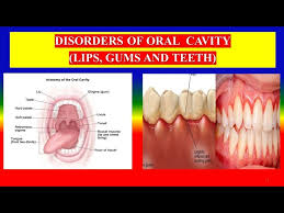 cavity lips gums and teeth