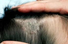 natural remes to cure scalp fungus