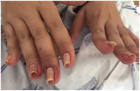 pincer nail in a lupus patient t h v