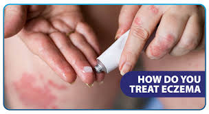 how do you treat eczema unilab
