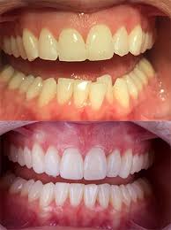 The pain is caused by forcing teeth into a different position each time, and will go after a few days. Invisalign Braces Orthodontics Bupa Dental Care