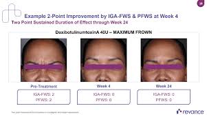 Revance Therapeutics A New Contender In The Botox Arena