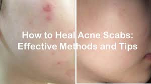 how to heal acne scabs effective