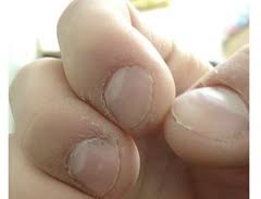 nail biting clified as ocd disorder