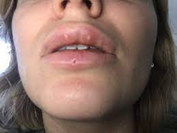 pus filled ps on lip after stylage