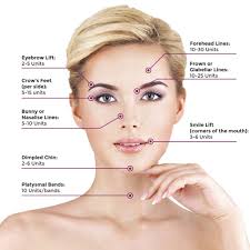 Common Areas For Botox Injection And Appropriate Units Per