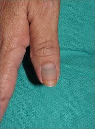 nail discoloration mdedge family cine
