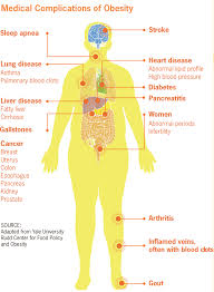 Difference Between Obesity And Morbid Obesity Difference