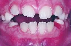 Image result for mixed dentition stages