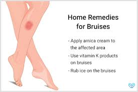 get rid of bruises with toothpaste