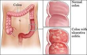 Diet Plan For Patients Of Ulcerative Colitis