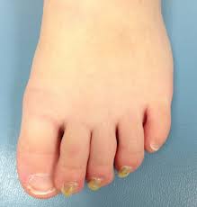 dystrophic toenails in a 4 year old boy