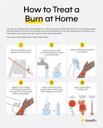 how to treat a burn at home a step by