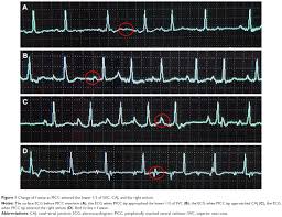 Full Text The Safety And Accuracy Of Ecg Guided Picc Tip