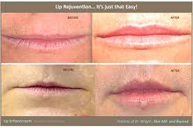 thin lips treatment plano tx flat