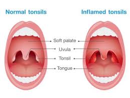 tonsils facts function treatment