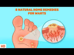 8 surprising home remes for warts