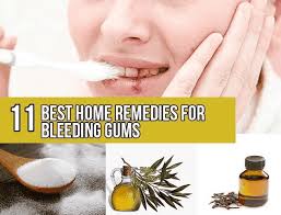 home remes for bleeding gums