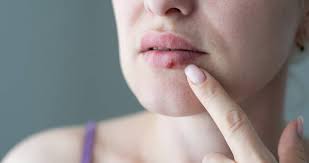 home remes for cold sores