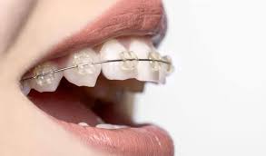 The orthodontist put 4 new brackets on 4 teeth that have. Do Ceramic Braces Take Longer Myorthodontist