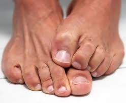 non treatments for toenail fungus