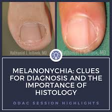 melanonychia clues for diagnosis and