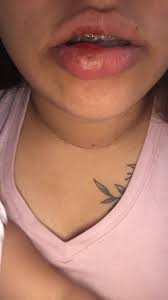 mom yellow lip swollen july 2017