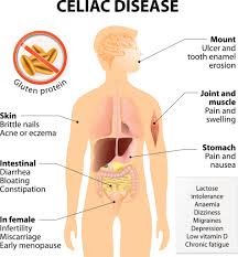 Celiac Disease And Celiac Disease Diet The Beginners Guide