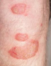 Skin rashes can include skin bumps that look like pimples or sores; Foot Rash Causes Symptoms Treatment