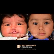 cleft palate surgery cleft lip repair