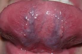 caviar tongue are dental hygiene