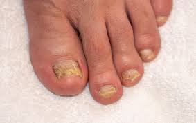why are my toenails yellow here are 4
