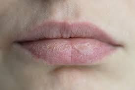 lips get dry and chapped and how to fix