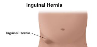 hernia repair surgery treatment los