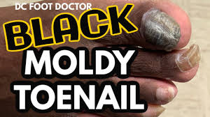 fungal toenail black moldy toenail