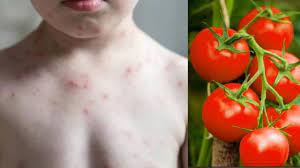 बच्चों में फैल रहा है ये नए तरीके का बुखार, जानिए Tomato Fever के लक्षण और  बचाव के उपाय - Tomato Fever is spreading among children, know the symptoms  and prevention measures -