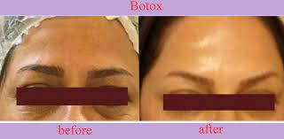 after botox what to do for better