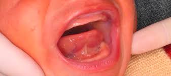 about tongue ties dental solutions of