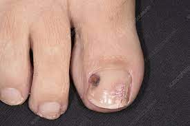 bruised toenail stock image c049