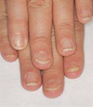 Nail Disorders And Systemic Disease What The Nails Tell Us