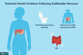 digestive problems after gallbladder